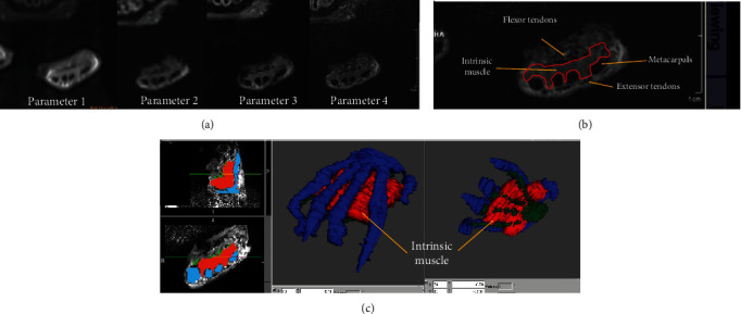 Impaired Limb Functional Outcome of Peripheral Nerve Regeneration Is Marked by Incomplete Recovery of Paw Muscle Atrophy and Brain Functional Connectivity in a Rat Forearm Nerve Repair Model.