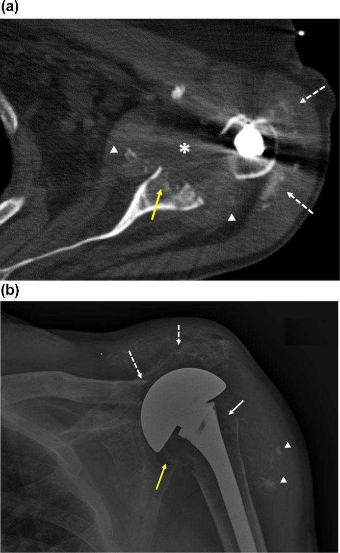 <i>Mycobacterium bovis</i> BCG osteoarticular infection complicating immune therapy for bladder cancer: a case report.