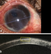 Massive corneal-epibulbar dermoid managed with pre-descemetic DALK and SLET.