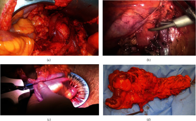 Laparoscopic versus Open Complete Mesocolic Excision for Right Colon Cancer.