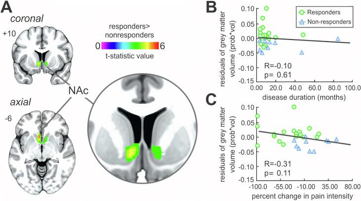 Pain stickiness in pediatric complex regional pain syndrome: A role for the nucleus accumbens
