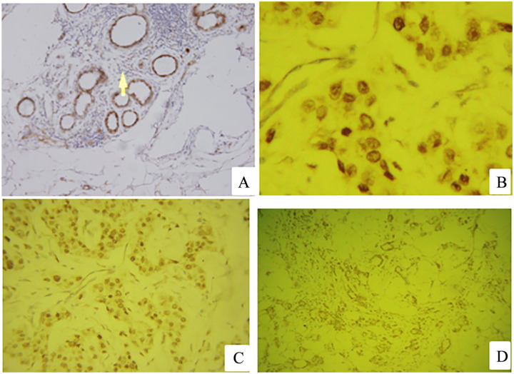 The Prognostic Value of Estrogen Receptor β Isoform With Correlation of Estrogen Receptor α Among Sudanese Breast Cancer Patients.