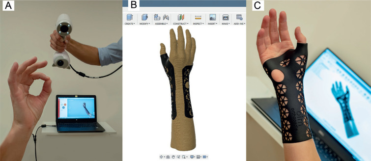 Production Time and User Satisfaction of 3-Dimensional Printed Orthoses For Chronic Hand Conditions Compared With Conventional Orthoses: A Prospective Case Series.