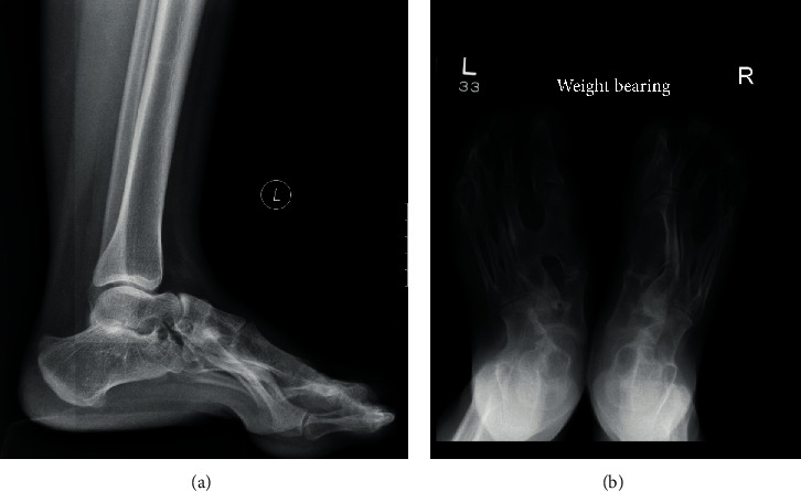 Intermetatarsal Coalition: Case Report, Literature Review, and Imaging Findings of an Underrecognized and Underdiagnosed Cause of Foot Pain.