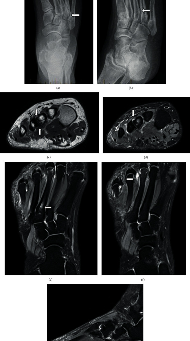 Intermetatarsal Coalition: Case Report, Literature Review, and Imaging Findings of an Underrecognized and Underdiagnosed Cause of Foot Pain.