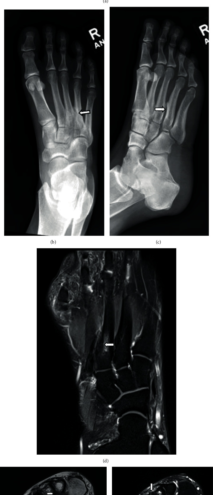 Intermetatarsal Coalition: Case Report, Literature Review, and Imaging Findings of an Underrecognized and Underdiagnosed Cause of Foot Pain.