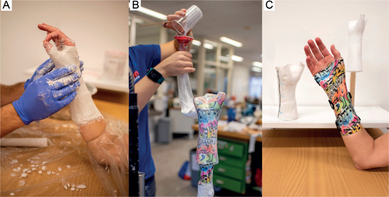 Production Time and User Satisfaction of 3-Dimensional Printed Orthoses For Chronic Hand Conditions Compared With Conventional Orthoses: A Prospective Case Series.