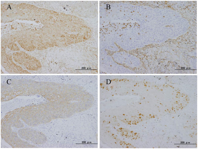 Prognostic Impact of Sphingosine Kinase 1 in Nonsmall Cell Lung Cancer.