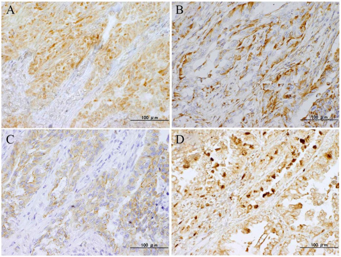 Prognostic Impact of Sphingosine Kinase 1 in Nonsmall Cell Lung Cancer.