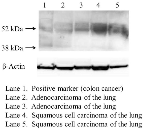 Prognostic Impact of Sphingosine Kinase 1 in Nonsmall Cell Lung Cancer.