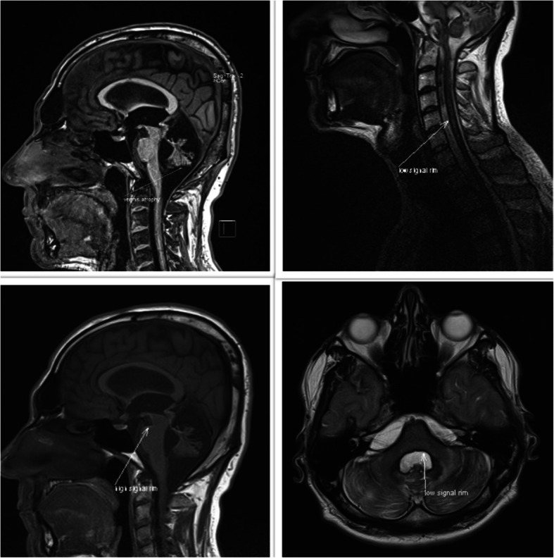 Idiopathic superficial siderosis of the central nervous system.