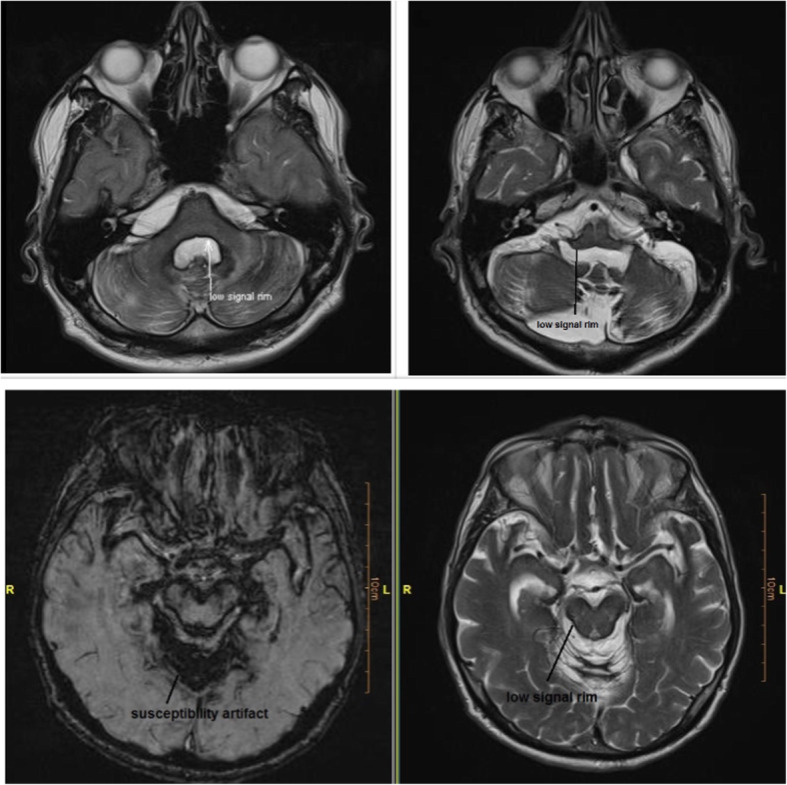 Idiopathic superficial siderosis of the central nervous system.