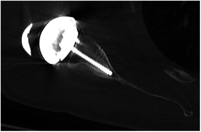 Tomographic Analysis of Positioning of Reverse Baseplates Positioning.