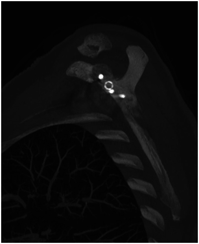 Tomographic Analysis of Positioning of Reverse Baseplates Positioning.