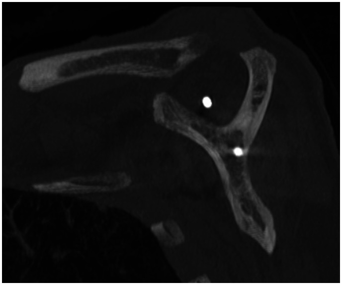 Tomographic Analysis of Positioning of Reverse Baseplates Positioning.