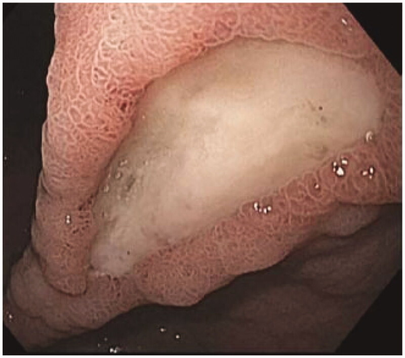 Prevalence of <i>Helicobacter pylori</i> infection and the incidence of the associated malignant and peptic ulcer disease (PUD) at Nelson Mandela Academic Hospital: a retrospective analysis.