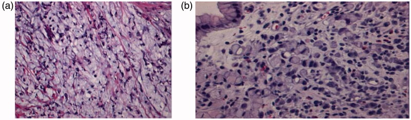 Prevalence of <i>Helicobacter pylori</i> infection and the incidence of the associated malignant and peptic ulcer disease (PUD) at Nelson Mandela Academic Hospital: a retrospective analysis.