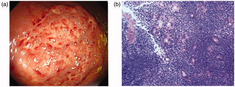 Prevalence of <i>Helicobacter pylori</i> infection and the incidence of the associated malignant and peptic ulcer disease (PUD) at Nelson Mandela Academic Hospital: a retrospective analysis.