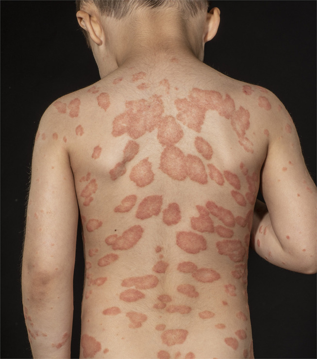 Off-Label Treatments for Pediatric Psoriasis: Lessons for the Clinic.