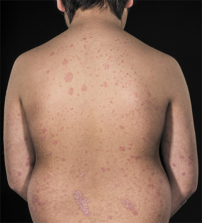 Off-Label Treatments for Pediatric Psoriasis: Lessons for the Clinic.