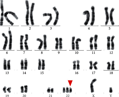 A De Novo sSMC (22) Characterized by High-Resolution Chromosome Microarray Analysis in a Chinese Boy with Cat-Eye Syndrome.