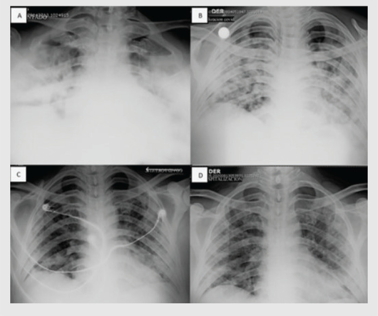 Alternative to traditional noninvasive ventilation using a modified snorkel mask in a patient with SARS-COV2: A case report.