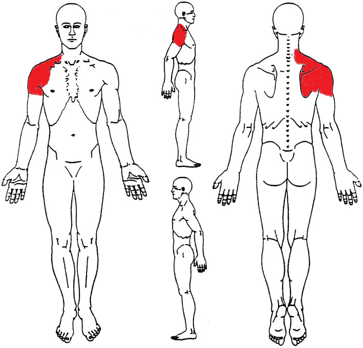 An unusual presentation of acute myocardial infarction in physiotherapy direct access: findings from a case report.