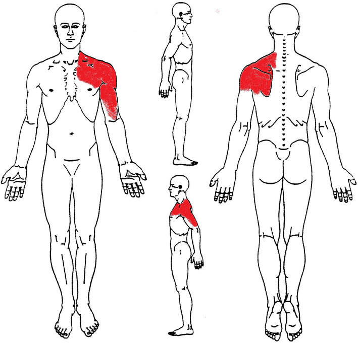 An unusual presentation of acute myocardial infarction in physiotherapy direct access: findings from a case report.