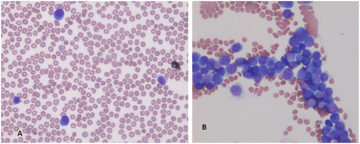 Management of Primary Plasma Cell Leukemia Remains Challenging Even in the Era of Novel Agents.