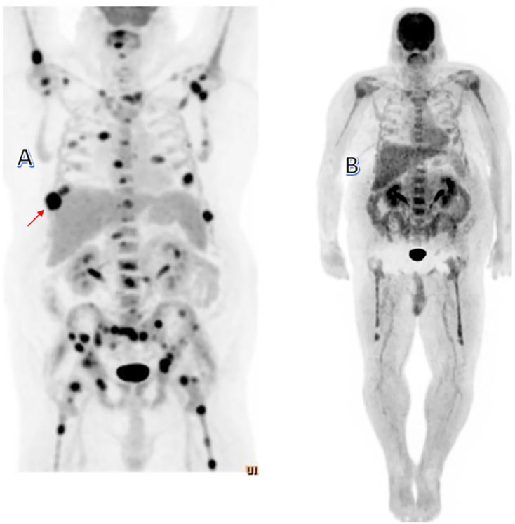 Management of Primary Plasma Cell Leukemia Remains Challenging Even in the Era of Novel Agents.