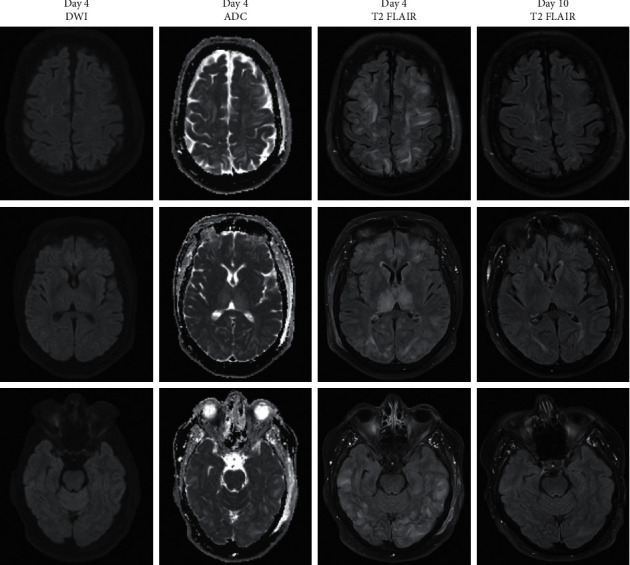 Cognitive Sequelae of Central-Variant Posterior Reversible Encephalopathy Syndrome (PRES).