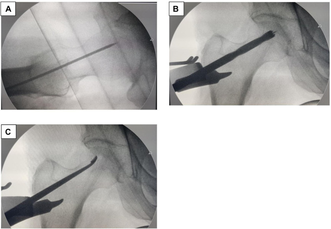 Retrospective Study on Implantation of Autologous-Cultured Osteoblasts for the Treatment of Patients with Avascular Necrosis of the Femoral Head.