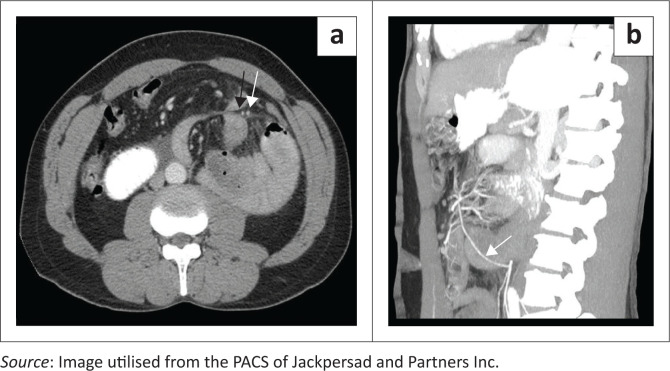 Left paraduodenal hernia: Embryological and radiological findings.