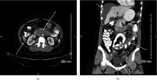 ACE Inhibitor Induced Isolated Angioedema of the Small Bowel: A Rare Complication of a Common Medication.