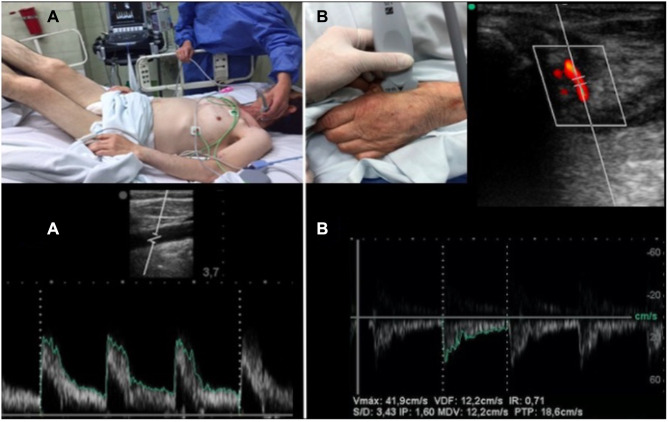 USER Protocol as a Guide to Resuscitation of the Patient with Septic Shock in the Emergency Department.