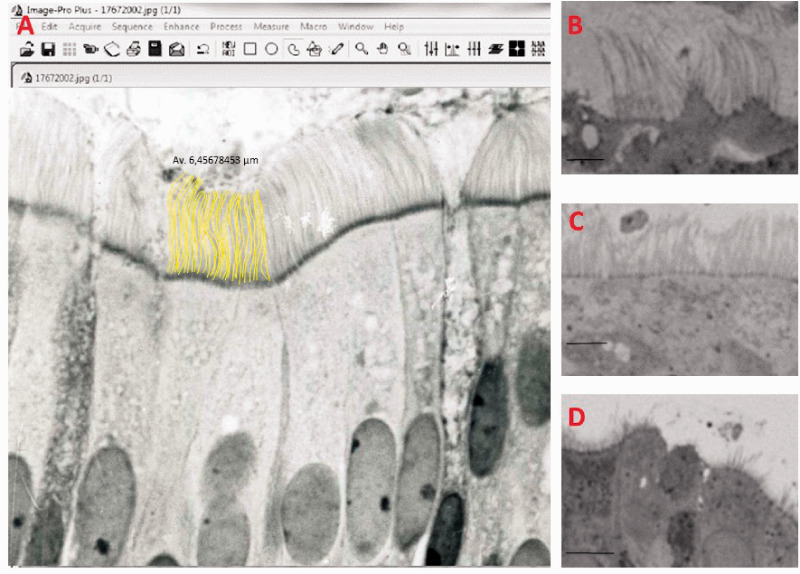 IFT46 Expression in the Nasal Mucosa of Primary Ciliary Dyskinesia Patients: Preliminary Study.