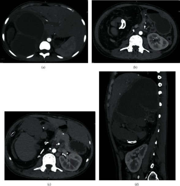 Fetus in Fetu in an Adult Female and Brief Review of Literature.