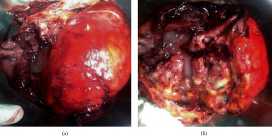 Fetus in Fetu in an Adult Female and Brief Review of Literature.