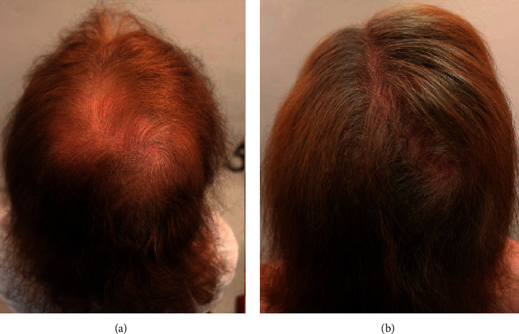 A Multimodal Hair-Loss Treatment Strategy Using a New Topical Phytoactive Formulation: A Report of Five Cases.