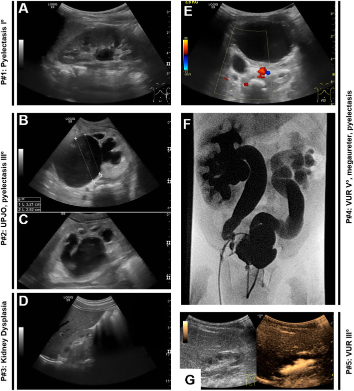 Molecular causes of congenital anomalies of the kidney and urinary tract (CAKUT).