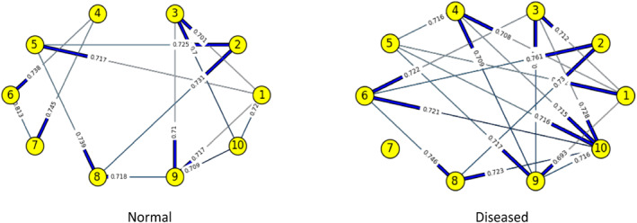 Identifying the degree of genetic interactions using Restricted Boltzmann Machine-A study on colorectal cancer.