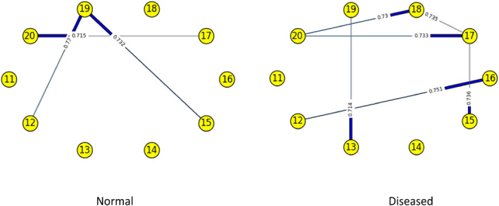 Identifying the degree of genetic interactions using Restricted Boltzmann Machine-A study on colorectal cancer.