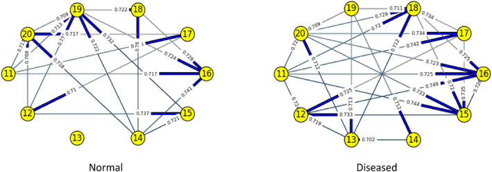 Identifying the degree of genetic interactions using Restricted Boltzmann Machine-A study on colorectal cancer.