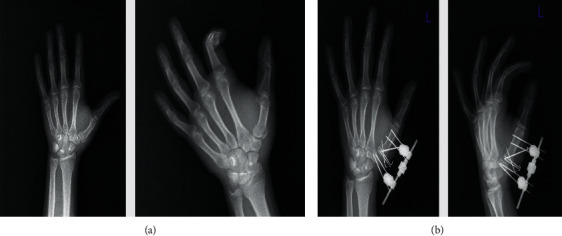 A Safe Method for Early Rehabilitation of Articular Fracture at the Base of Thumb Metacarpal Bone.