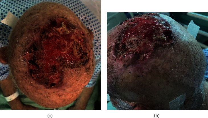 Giant Basal Cell Carcinoma of the Scalp with Intracranial Invasion: MRI Findings with Tract Visualisation.