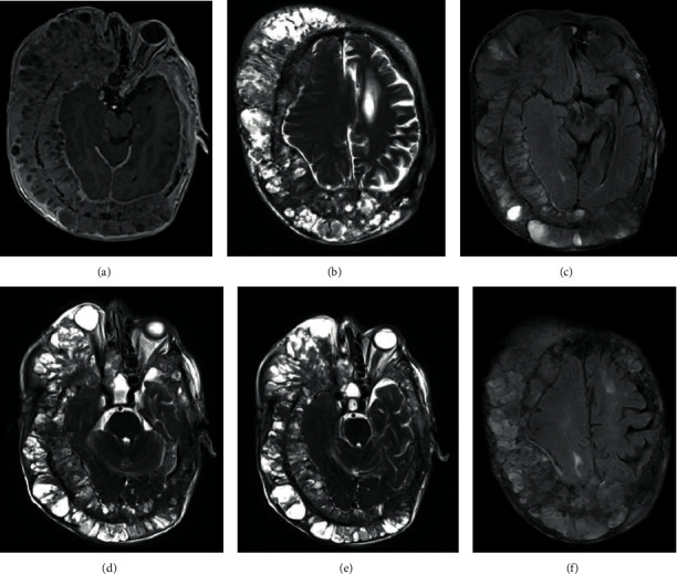 Giant Basal Cell Carcinoma of the Scalp with Intracranial Invasion: MRI Findings with Tract Visualisation.