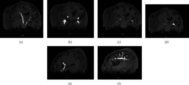 Giant Basal Cell Carcinoma of the Scalp with Intracranial Invasion: MRI Findings with Tract Visualisation.