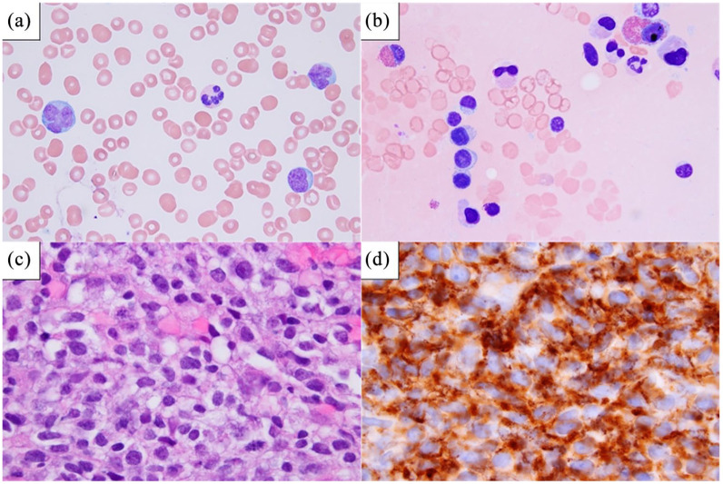 A Clinical Triad with Fatal Implications: Recrudescent Diffuse Large B-cell Non-Hodgkin Lymphoma Presenting in the Leukemic Phase with an Elevated Serum Lactic Acid Level and Dysregulation of the TP53 Tumor Suppressor Gene - A Case Report and Literature Review.