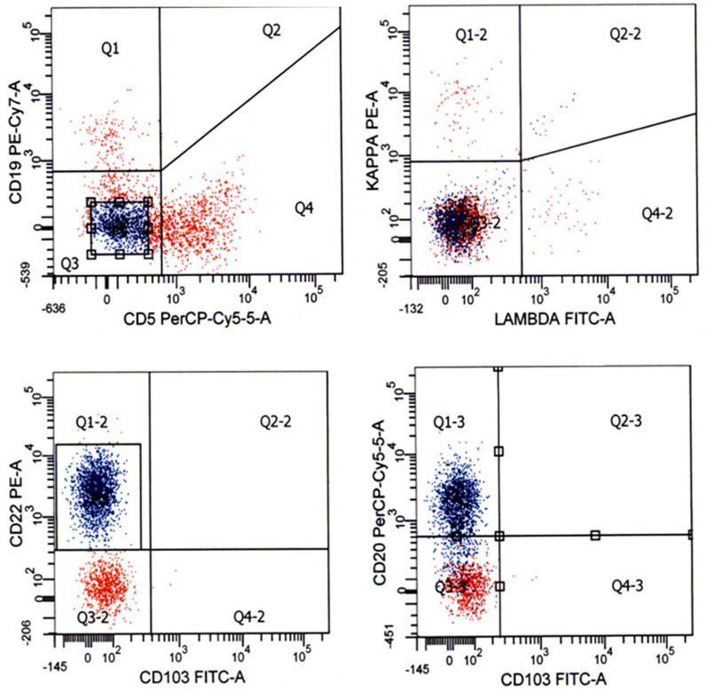 A Clinical Triad with Fatal Implications: Recrudescent Diffuse Large B-cell Non-Hodgkin Lymphoma Presenting in the Leukemic Phase with an Elevated Serum Lactic Acid Level and Dysregulation of the TP53 Tumor Suppressor Gene - A Case Report and Literature Review.