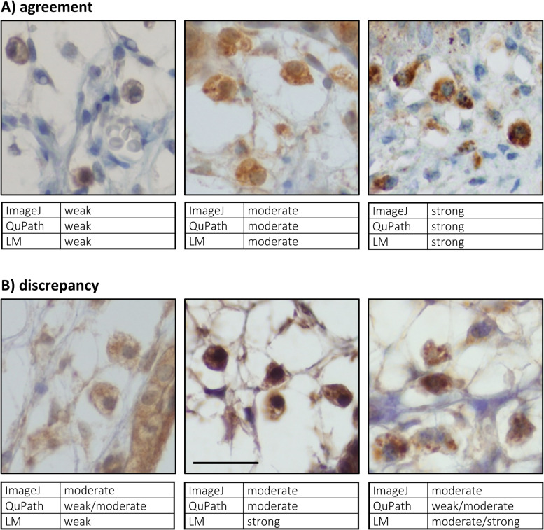 Comparative Analysis of Immunohistochemical Staining Intensity Determined by Light Microscopy, ImageJ and QuPath in Placental Hofbauer Cells.